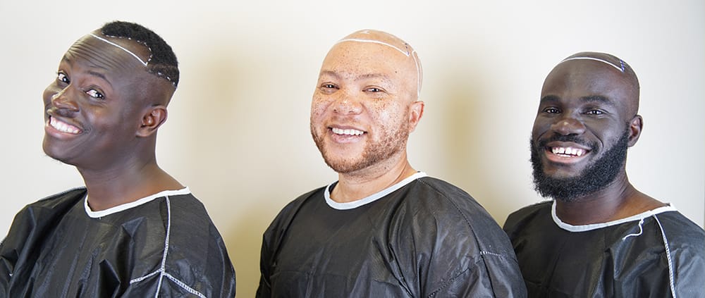 Les Greffes de Cheveux Ont-elles un Aspect Naturel Les Greffes de Cheveux Ont-elles un Aspect Naturel ?
