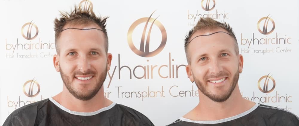 Greffe de cheveux est-ce douloureux 21 Greffe de cheveux est-ce douloureux