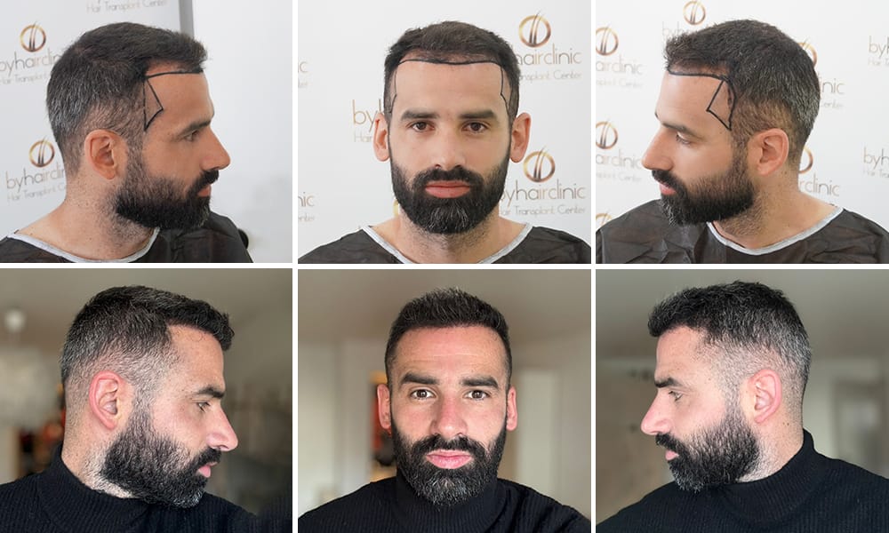 Les Greffes de Cheveux Ont-elles un Aspect Naturel ? 22 Le résultat de greffe de cheveux d’un traçage naturel