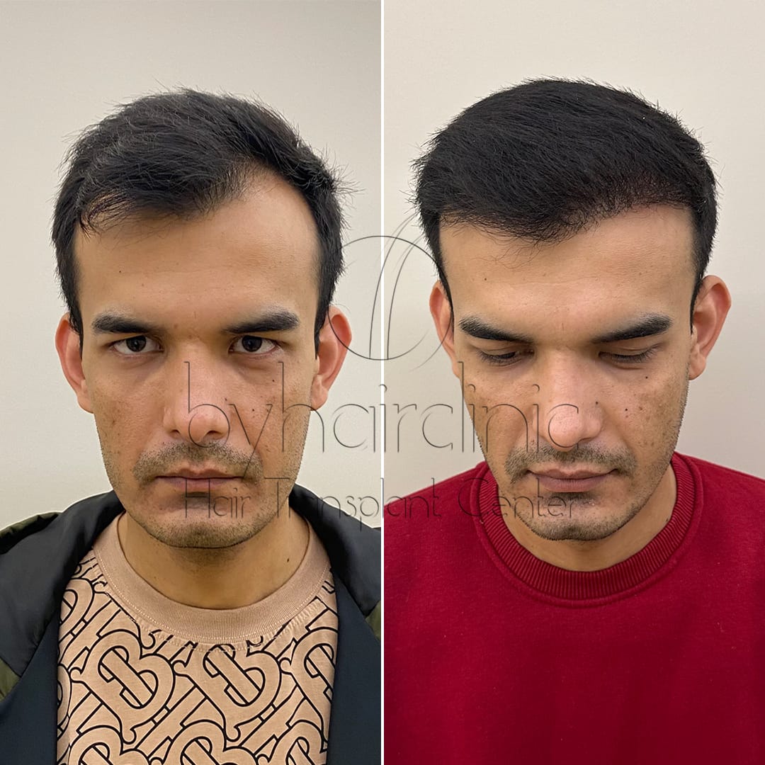 Before and after 9 months of hair restoration Before and after 9 months of hair restoration