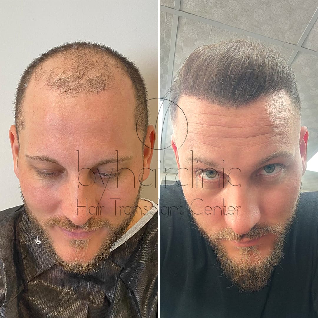 8-month hair transplant results, before and after photos 8-month hair transplant results, before and after photos