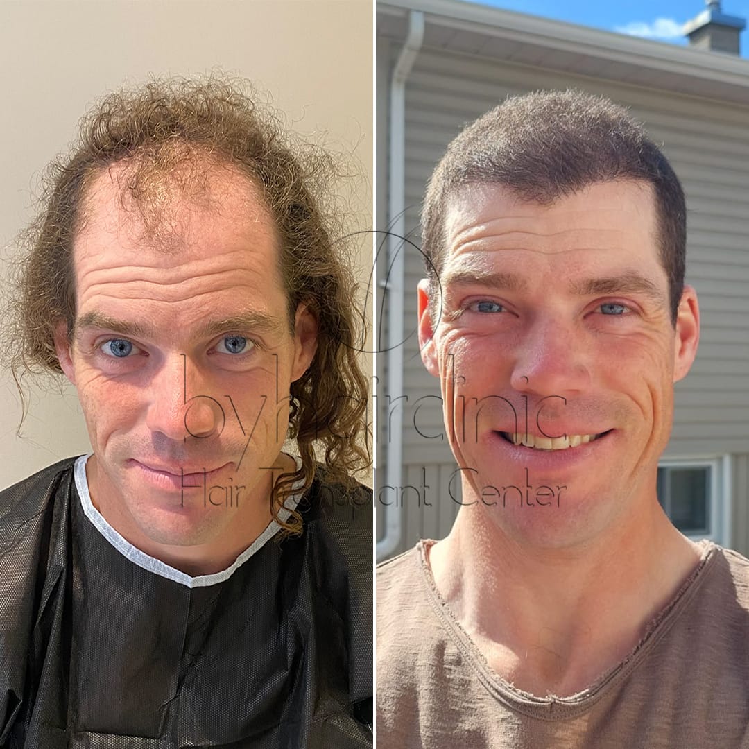 Hair transplant result before and after 6 months Hair transplant result before and after 6 months
