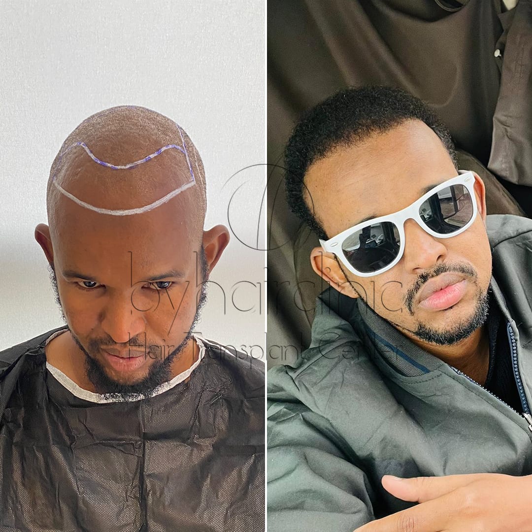 Hair transplant result before and after 6 months Hair transplant result before and after 6 months