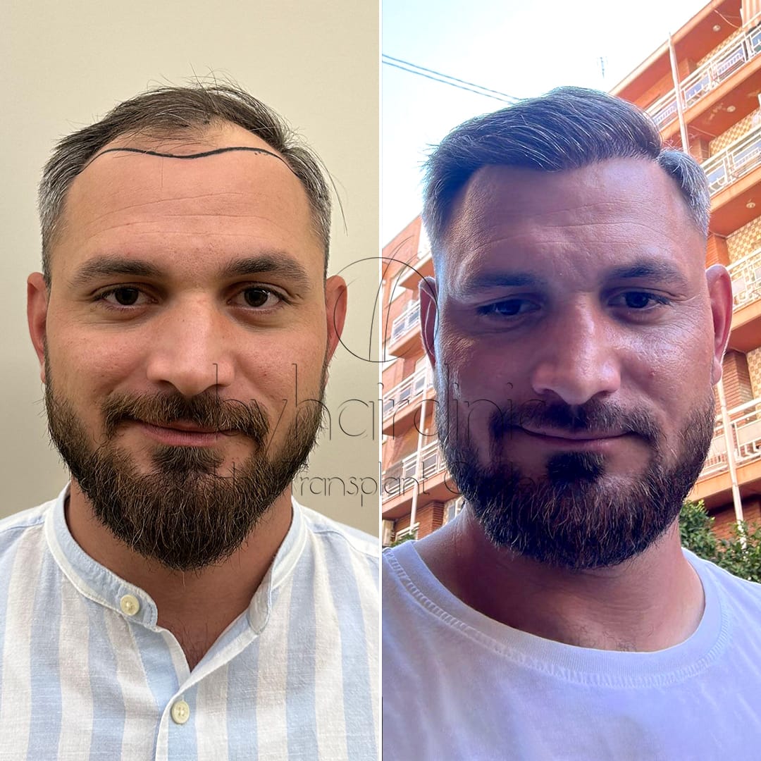 Hair transplant result before and after 6 months Hair transplant result before and after 6 months