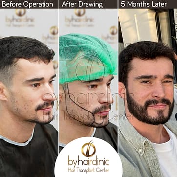 Trasplante de Barba y Bigote en Turquía 2 Zona donante utilizada en el Trasplante de Barba y Bigote