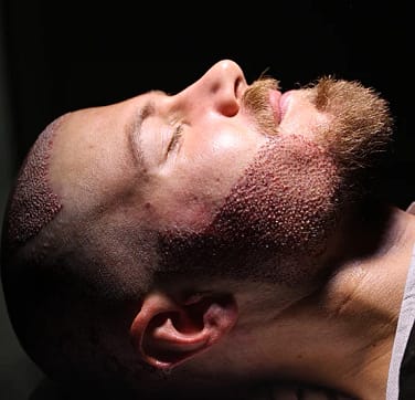 Trasplante de Barba y Bigote en Turquía 1 Trasplante de Barba y Bigote en Turquía byhairclinic