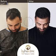 نتيجة زراعة شعر نوري عبد العالي