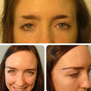 Greffe de Sourcils Turquie chez byhairclinic Istanbul