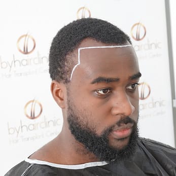 Les Greffes de Cheveux Ont-elles un Aspect Naturel ? 21 Les Greffes de Cheveux Ont-elles un Aspect Naturel ?