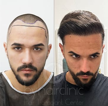 FUE Saphir, DHI, Sédation et Cellules Souches : Comparatif des Techniques Capillaires 1 Comparatif FUE Saphir DHI – résultat après une greffe FUE Saphir