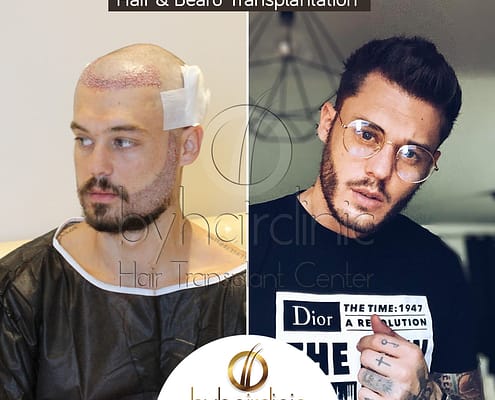 Steven Locatelli Greffe de Cheveux et Barbe Turquie 1 Steven Locatelli Greffe de Cheveux et Barbe Turquie