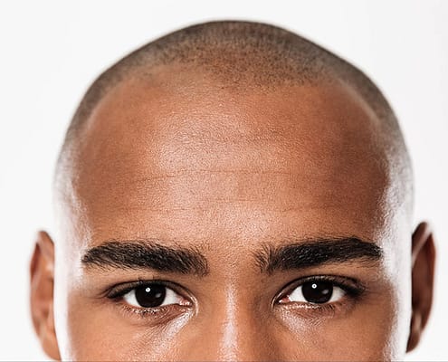 La greffe de cheveux peut-elle être pratiquée sur les personnes ayant des cheveux afro ? 15 La greffe de cheveux peut-elle être pratiquée sur les personnes ayant des cheveux afro ?