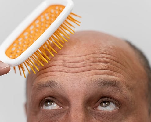 Tout ce que vous devez savoir sur la chute des cheveux chez les hommes 19 Male pattern baldness