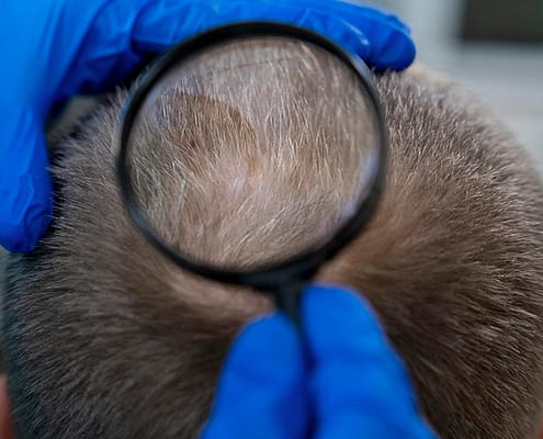 Quand les cicatrices de greffe de cheveux disparaissent-elles ? 16 Quand les cicatrices de greffe de cheveux disparaissent-elles ?