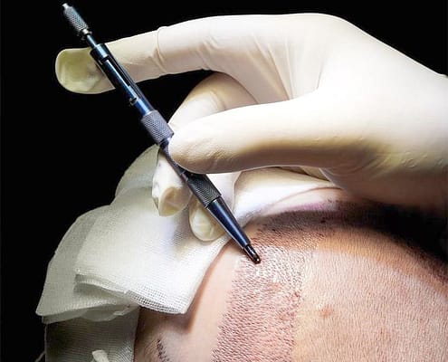 Sapphire FUE hair transplant procedure at byhairclinic Istanbul