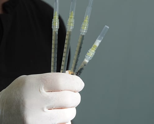 Greffe de Cheveux par Cellules Souches chez byhairclinic Istanbul