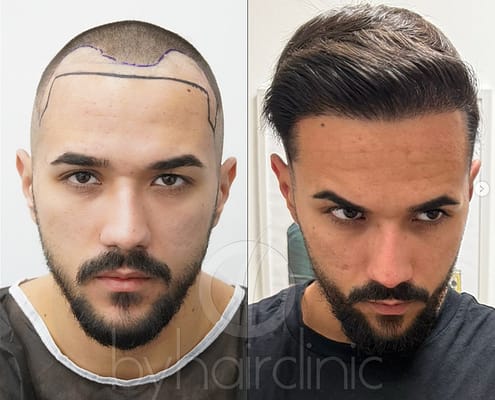 Comparatif FUE Saphir DHI – résultat après une greffe FUE Saphir