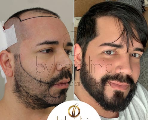 Resultado del trasplante capilar y de barba en Turquía Resultado del trasplante capilar y de barba en Turquía