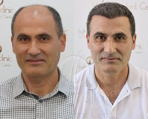 Trasplante Capilar Turquía Nuestra Clínica Trasplante Capilar Turquía Nuestra Clínica