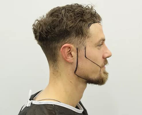 Zone donneuse pour greffe de barbe et moustache