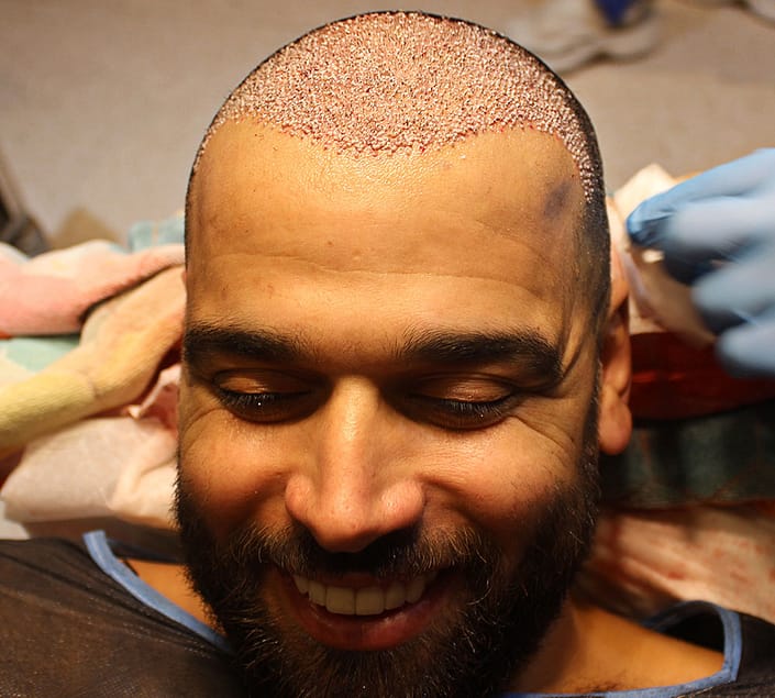 Nore Abdelali Hair Transplant Nore Abdelali Hair Transplant