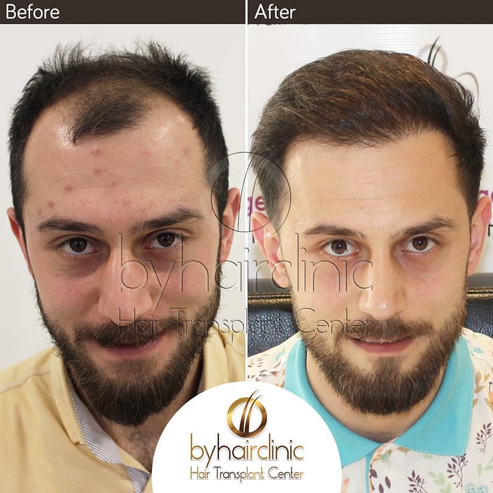 Haartransplantation Türkei Vorher und Nachher Haartransplantation Türkei Vorher und Nachher