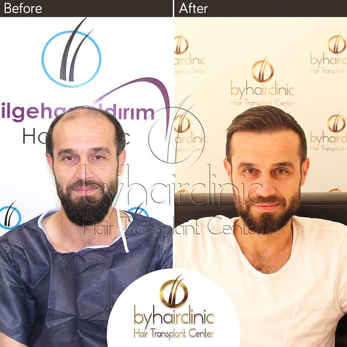 Haartransplantation Türkei Vorher und Nachher Haartransplantation Türkei Vorher und Nachher