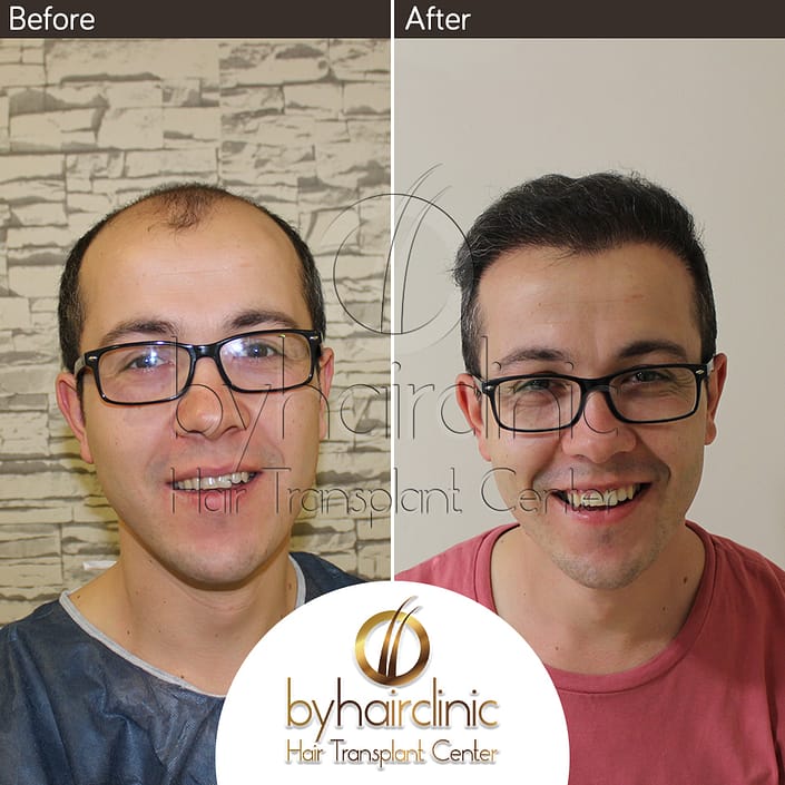 Haartransplantation Türkei Vorher und Nachher Haartransplantation Türkei Vorher und Nachher