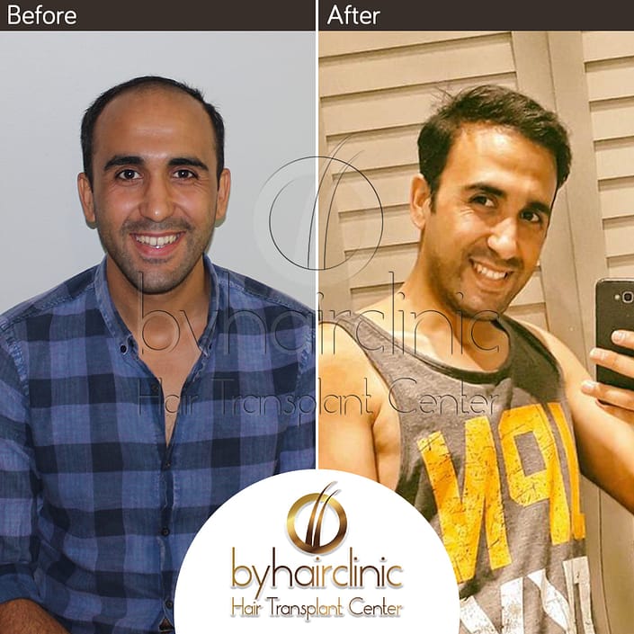 Haartransplantation Türkei Vorher und Nachher Haartransplantation Türkei Vorher und Nachher