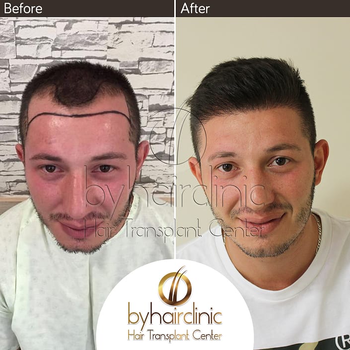 Haartransplantation Türkei Vorher und Nachher Haartransplantation Türkei Vorher und Nachher