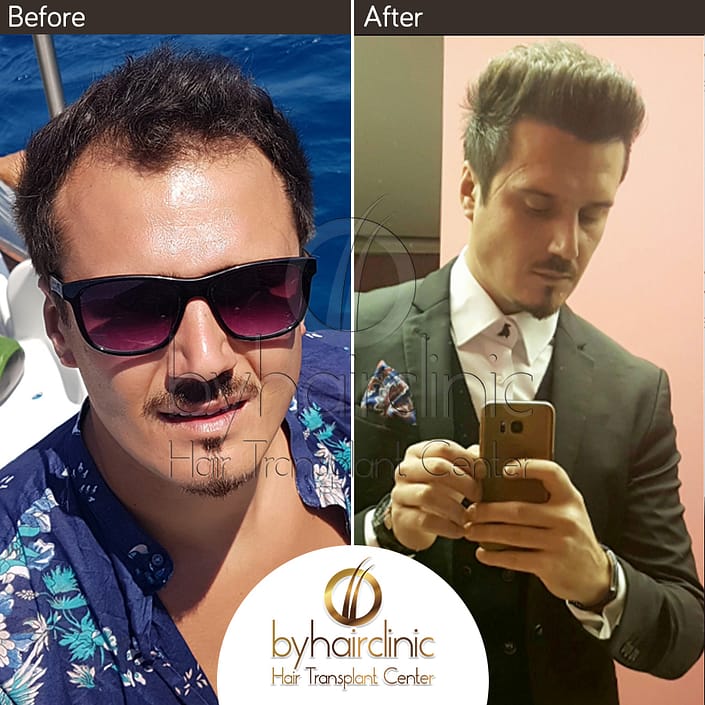 Haartransplantation Türkei Vorher und Nachher Haartransplantation Türkei Vorher und Nachher