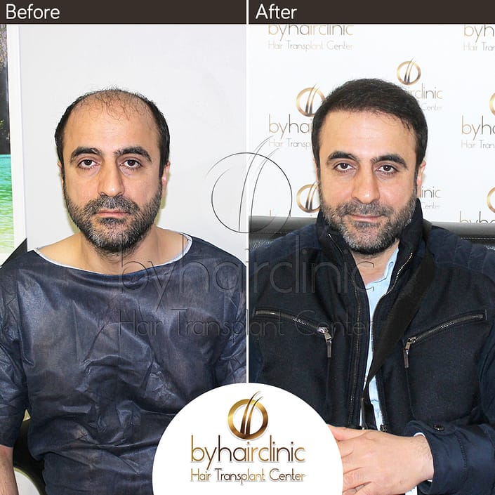 نتيجه عملية زراعة الشعر نتيجه عملية زراعة الشعر
