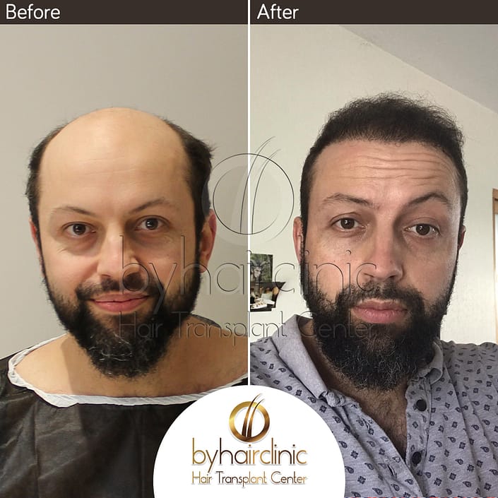 نتيجه عملية زراعة الشعر نتيجه عملية زراعة الشعر