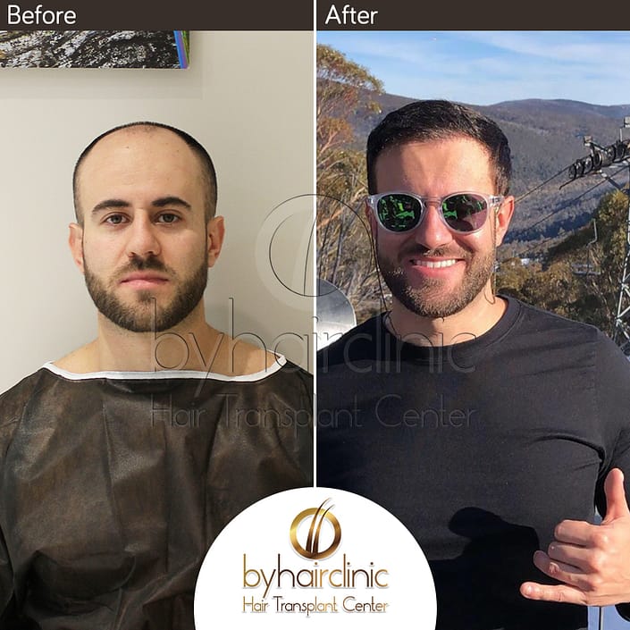 نتيجه عملية زراعة الشعر نتيجه عملية زراعة الشعر