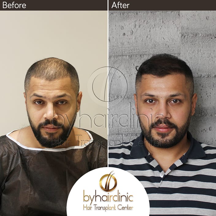 نتيجه عملية زراعة الشعر نتيجه عملية زراعة الشعر