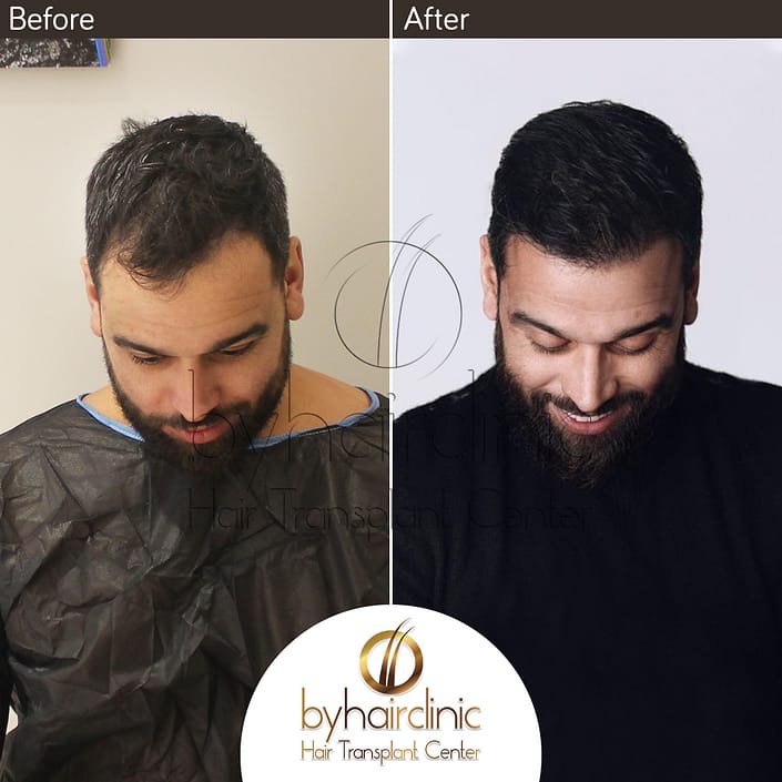 Nore Abdelali’s hair transplant result Nore Abdelali hair transplant result