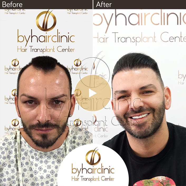 Hair Transplant Result Hair Transplant Result Turkey