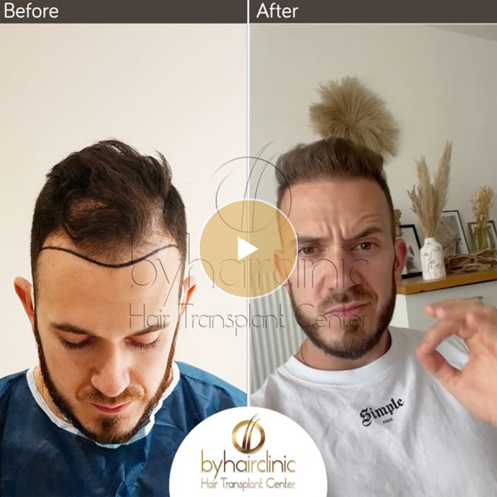 Video resultat de la greffe de cheveux Video resultat de la greffe de cheveux