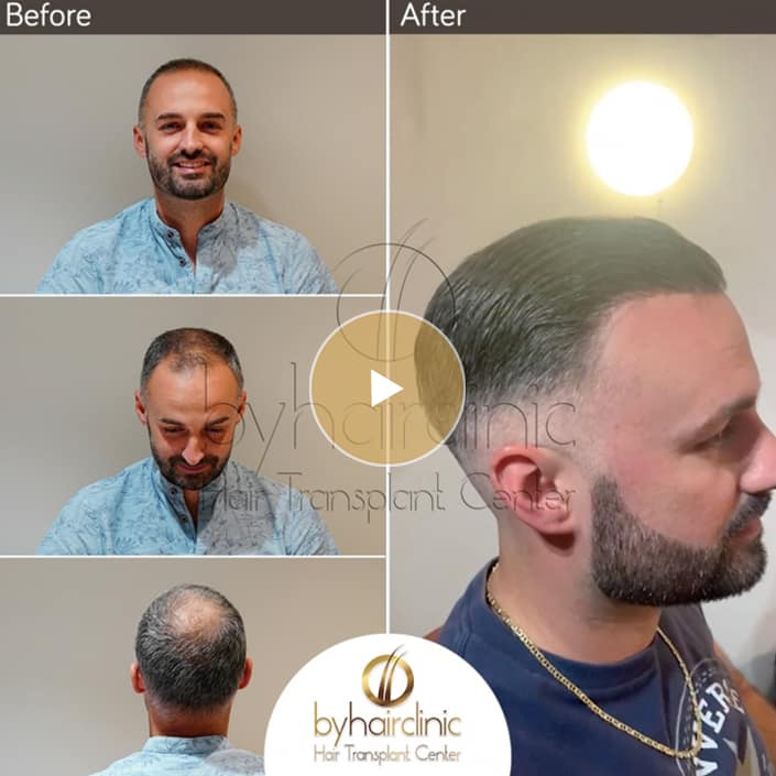 Hair Transplant Result Hair Transplant Result Turkey