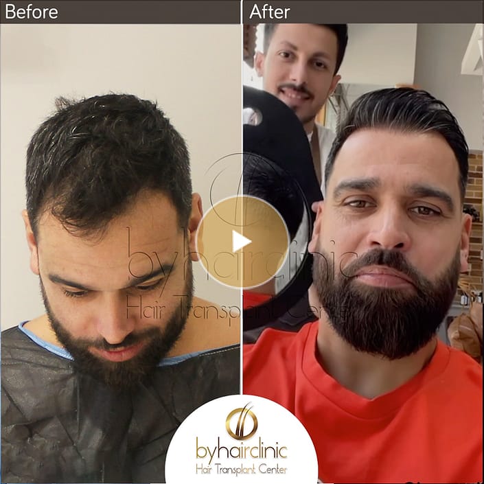 Greffe De Cheveux Turquie Avant et Après