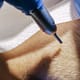 Hair Transplant Patient Information 1 Everything you need to know about hair transplantation