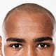 Can hair transplantation be performed on people with Afro-textured hair? 2 Afro textured hair
