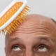 Tout ce que vous devez savoir sur la chute des cheveux chez les hommes 22 Male pattern baldness