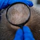 Quand les cicatrices de greffe de cheveux disparaissent-elles ? 22 Quand les cicatrices de greffe de cheveux disparaissent-elles ?