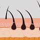 The Meaning of Hair Transplants What is a Transplant? 1 La signification des greffes capillaires