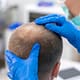 Les patients diabétiques peuvent-ils avoir une greffe de cheveux ? 23 Les patients diabétiques