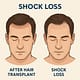 What Is Hair Transplant Shock Loss 2 What Is Hair Transplant Shock Loss