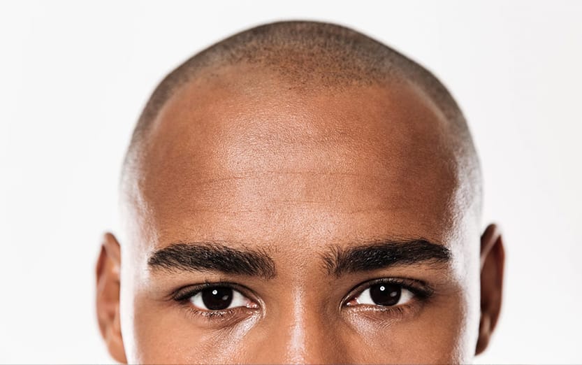 La greffe de cheveux peut-elle être pratiquée sur les personnes ayant des cheveux afro ? 21 La greffe de cheveux peut-elle être pratiquée sur les personnes ayant des cheveux afro ?
