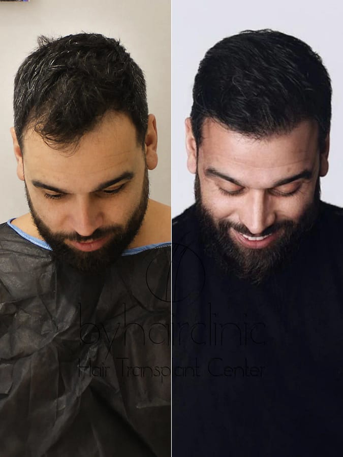 نتيجة زراعة شعر نوري عبد العالي قبل وبعد