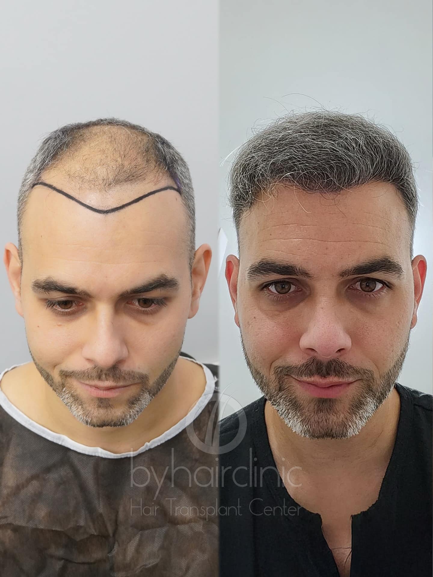 Résultat avant et après chez byhairclinic Istanbul